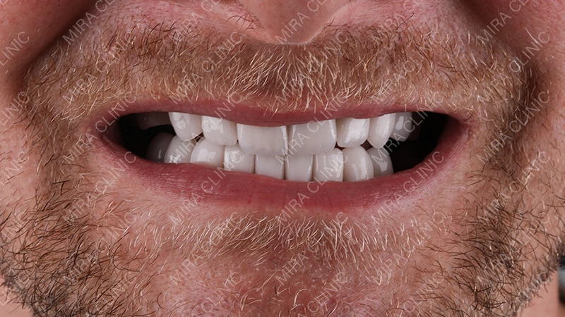 Hollywood smile The Result
